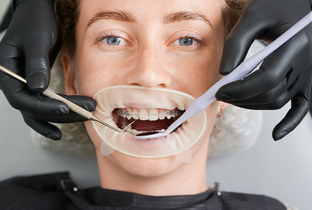 Inlays/Onlays - LQ DENTAL